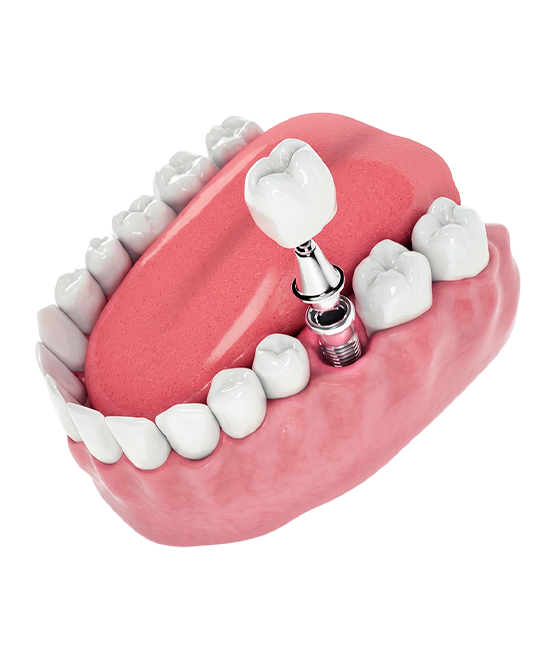 Implante dentário - Miranzi Odontologia